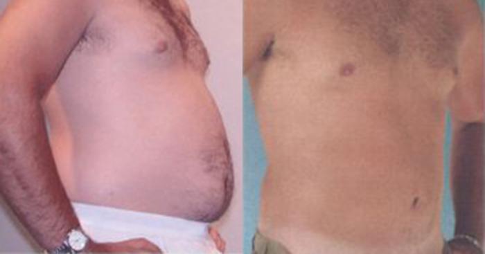 Before & After Liposuction Case 5295 View 2 View in Houston, TX
