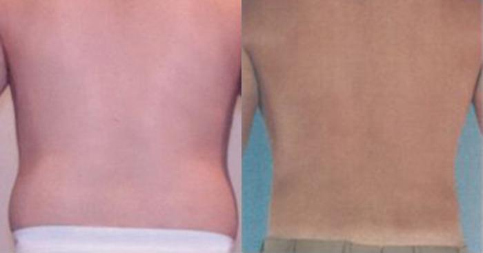 Before & After Liposuction Case 5295 View 3 View in Houston, TX