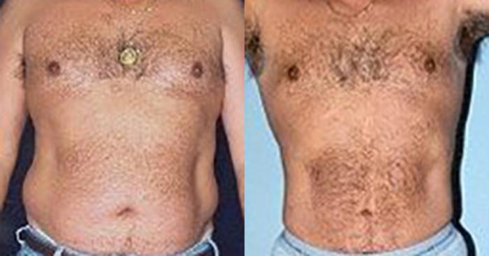 Before & After Liposuction Case 5307 View 1 View in Houston, TX