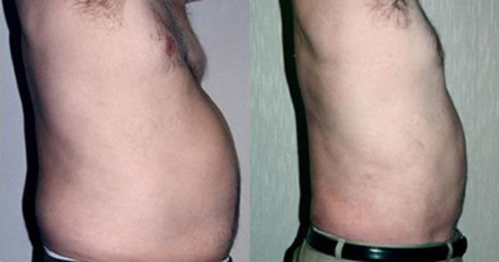 Before & After Liposuction Case 5332 View 1 View in Houston, TX