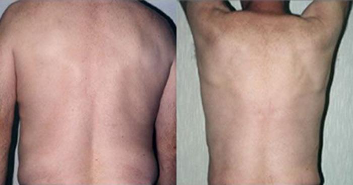 Before & After Liposuction Case 5332 View 2 View in Houston, TX