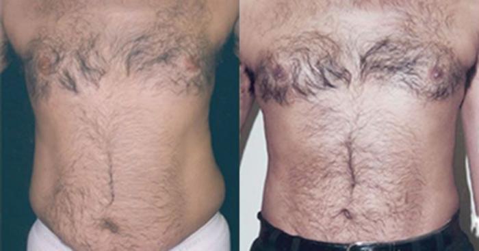 Before & After Liposuction Case 5343 View 1 View in Houston, TX