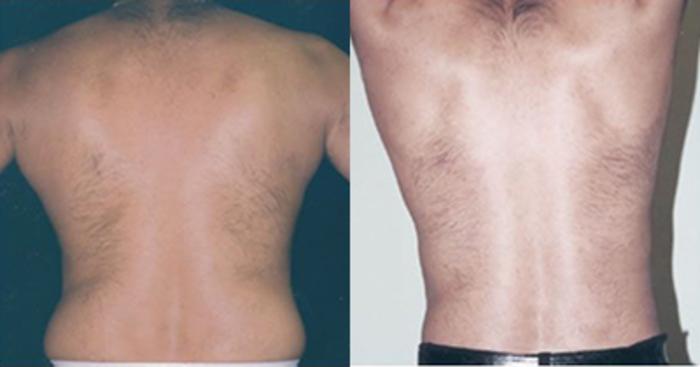 Before & After Liposuction Case 5343 View 2 View in Houston, TX