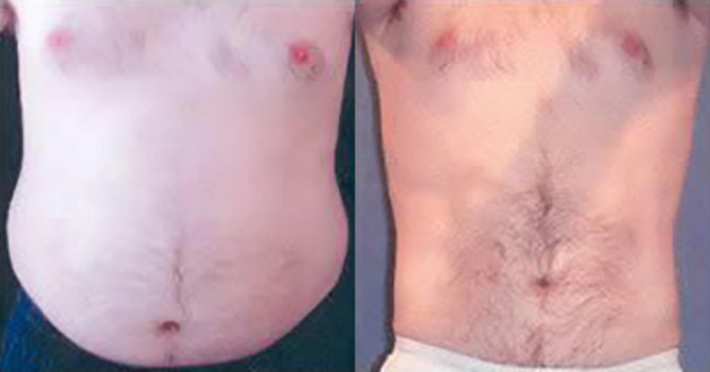 Before & After Liposuction Case 5350 View 1 View in Houston, TX