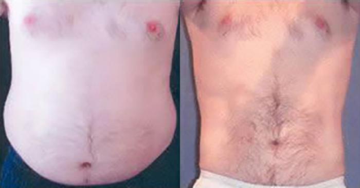 Before & After Liposuction Case 5350 View 1 View in Houston, TX