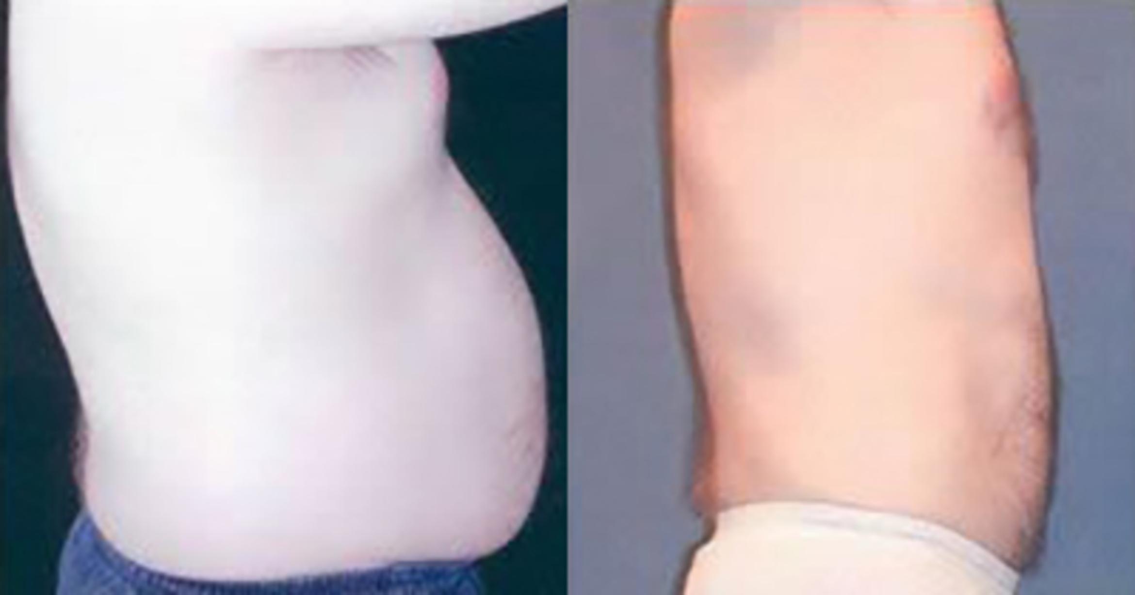 Before & After Liposuction Case 5350 View 2 View in Houston, TX