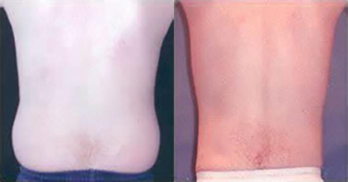 Before & After Liposuction Case 5350 View 3 View in Houston, TX