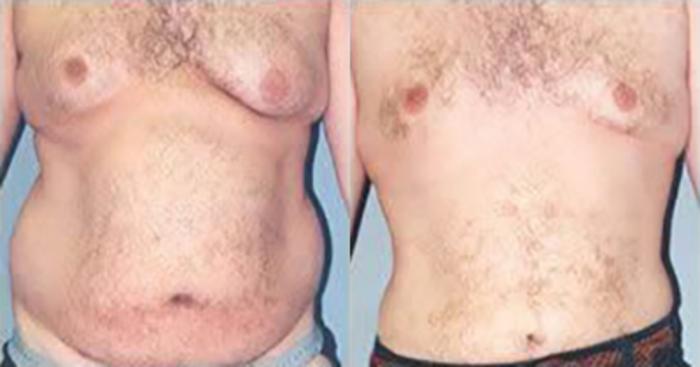 Before & After Liposuction Case 5358 View 1 View in Houston, TX