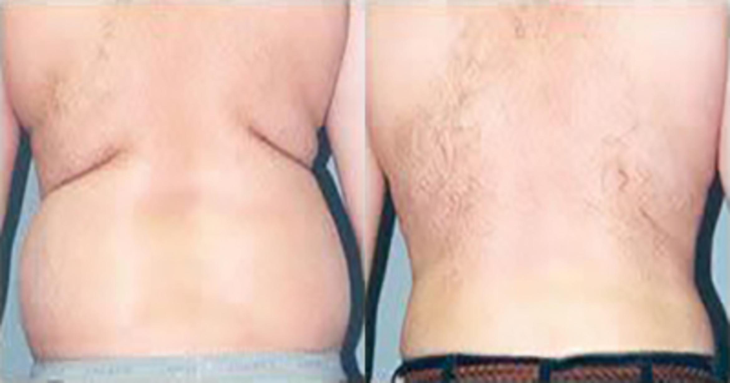 Before & After Liposuction Case 5358 View 2 View in Houston, TX