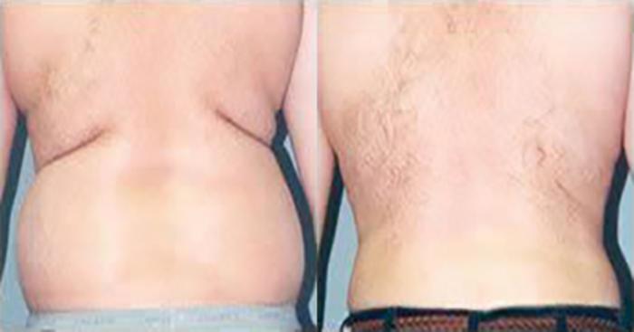 Before & After Liposuction Case 5358 View 2 View in Houston, TX