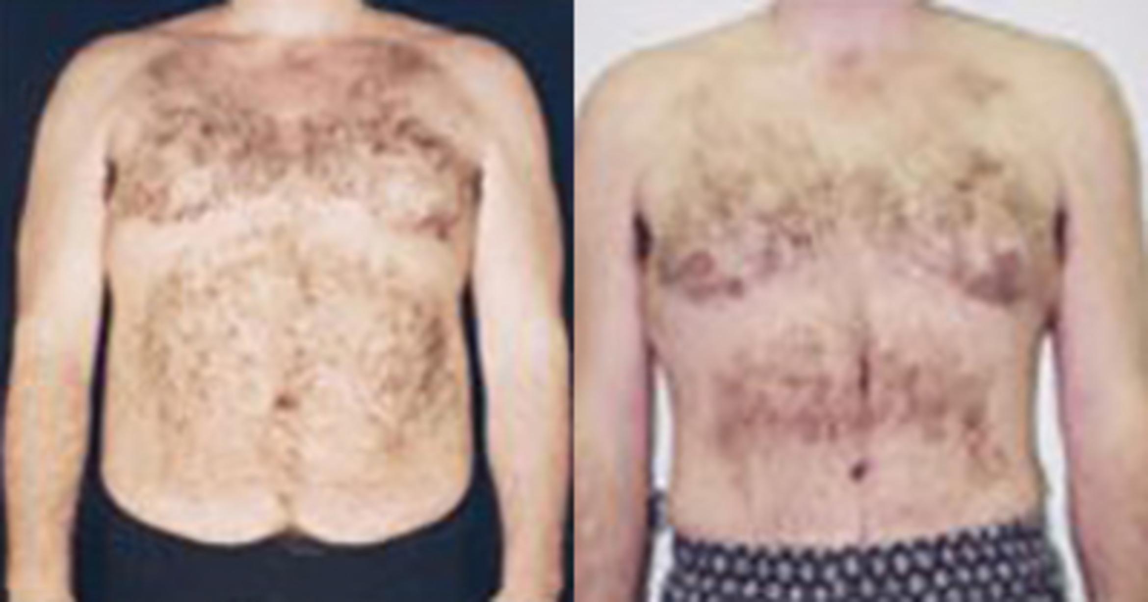 Before & After Liposuction Case 5372 View 1 View in Houston, TX