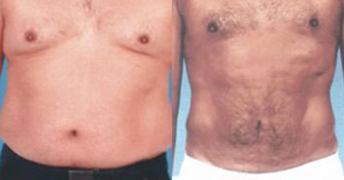 Before & After Liposuction Case 5376 View 1 View in Houston, TX