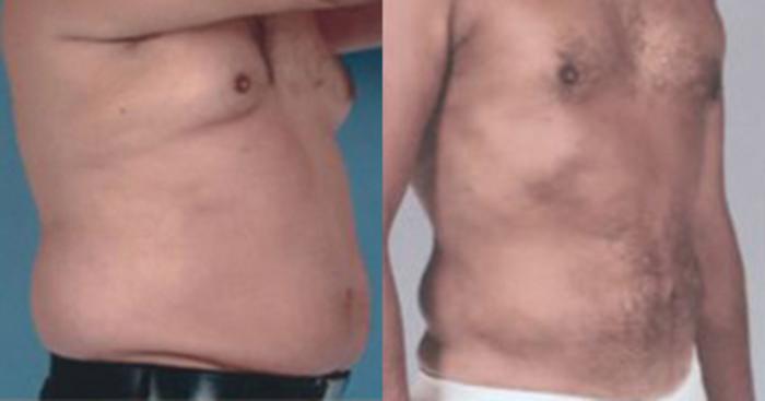 Before & After Liposuction Case 5376 View 2 View in Houston, TX