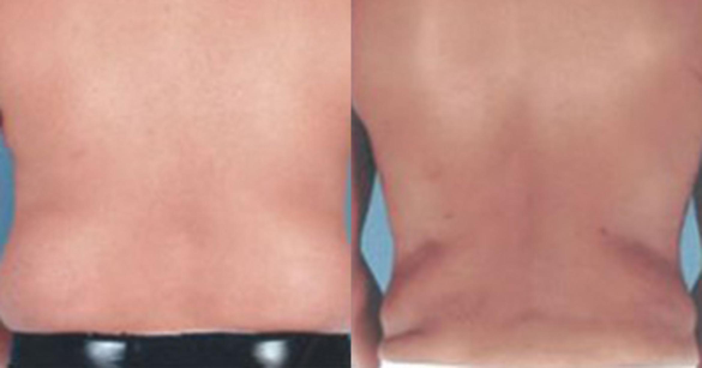 Before & After Liposuction Case 5376 View 3 View in Houston, TX