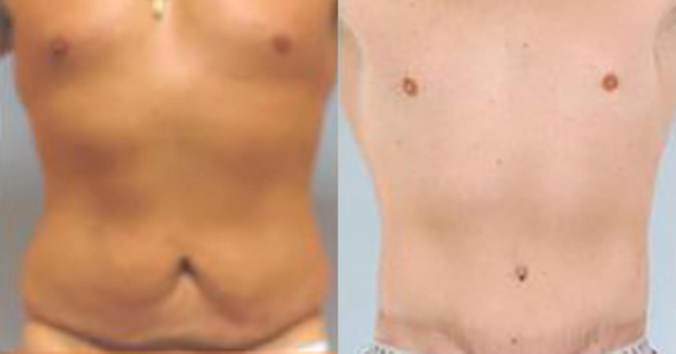 Before & After Liposuction Case 5384 View 1 View in Houston, TX