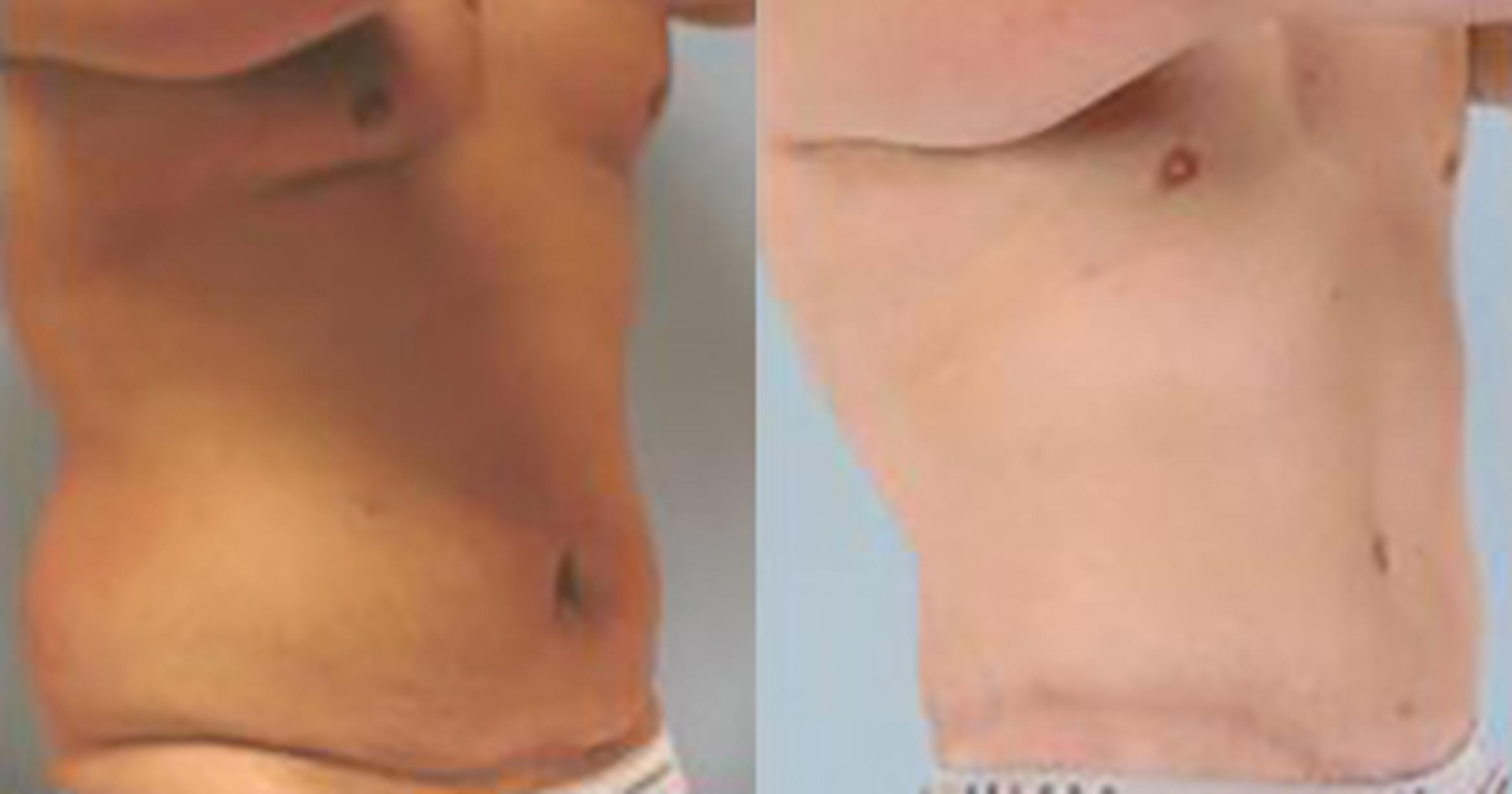 Before & After Liposuction Case 5384 View 2 View in Houston, TX