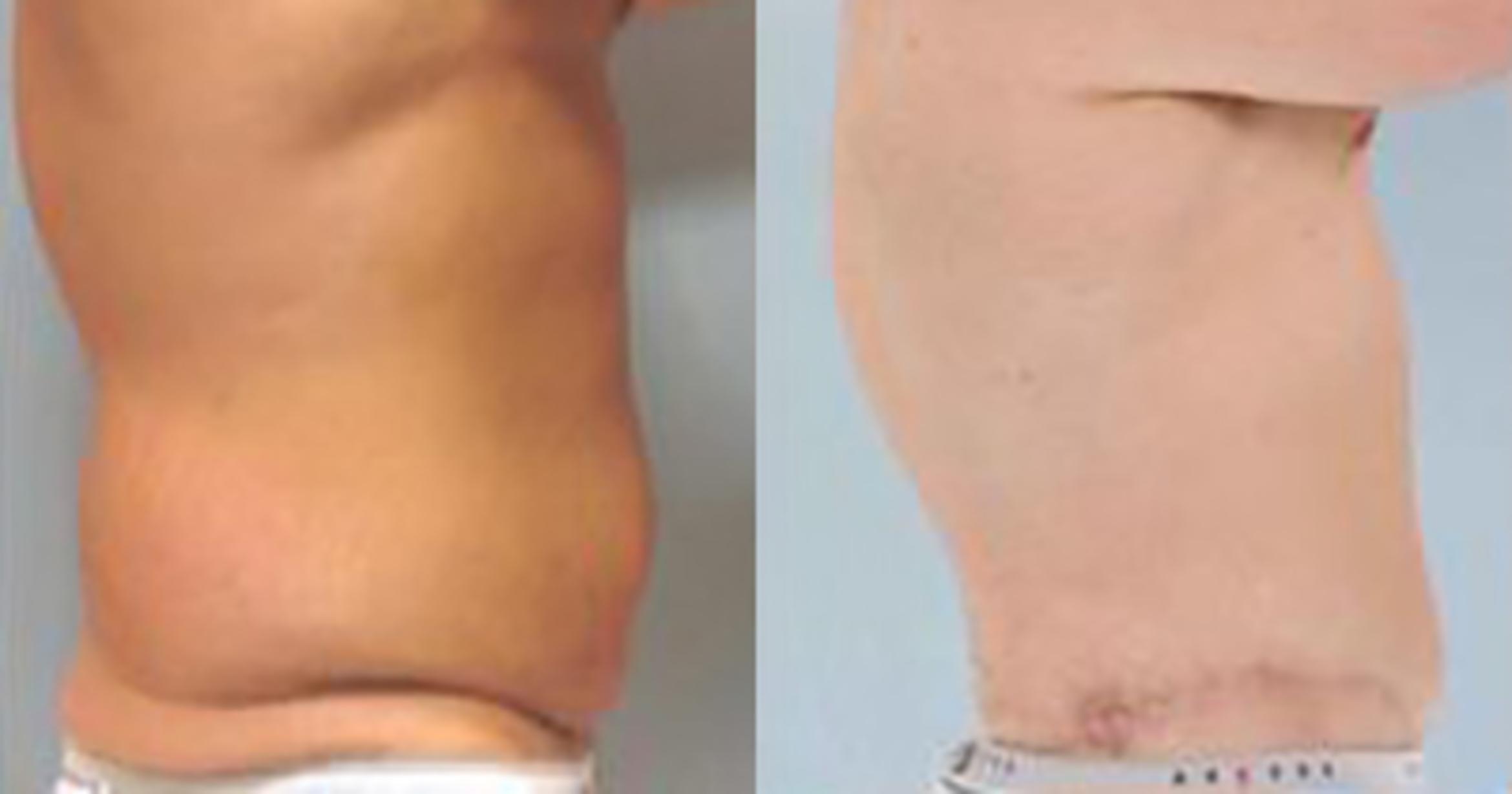 Before & After Liposuction Case 5384 View 3 View in Houston, TX