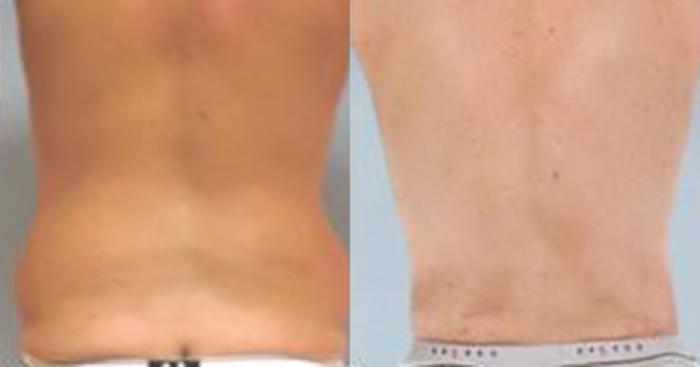 Before & After Liposuction Case 5384 View 4 View in Houston, TX