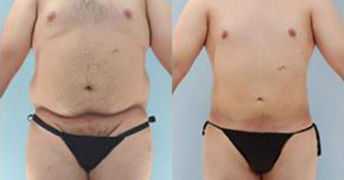 Before & After Liposuction Case 5394 View 1 View in Houston, TX