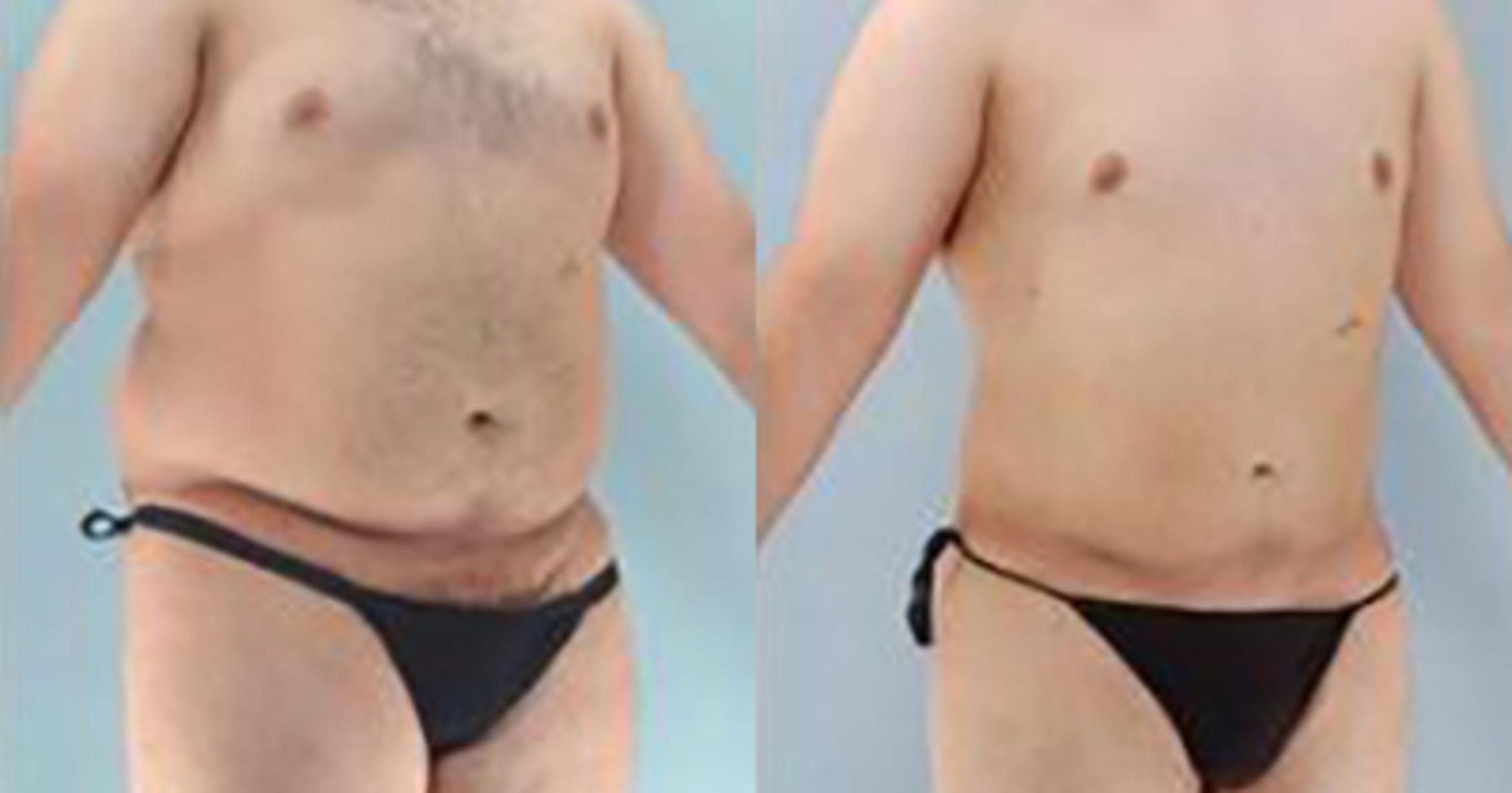 Before & After Liposuction Case 5394 View 2 View in Houston, TX