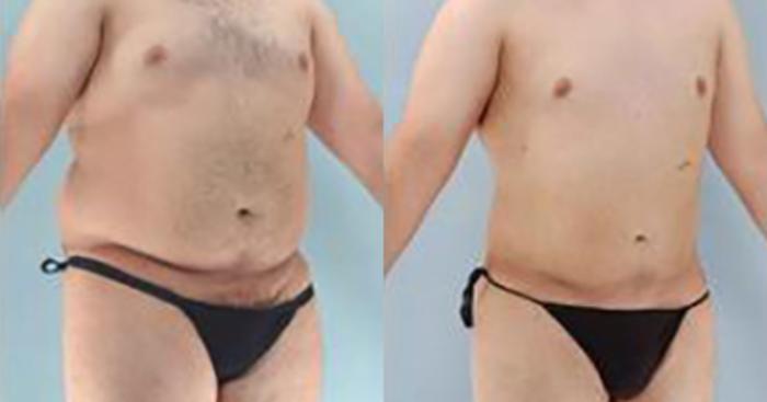 Before & After Liposuction Case 5394 View 2 View in Houston, TX