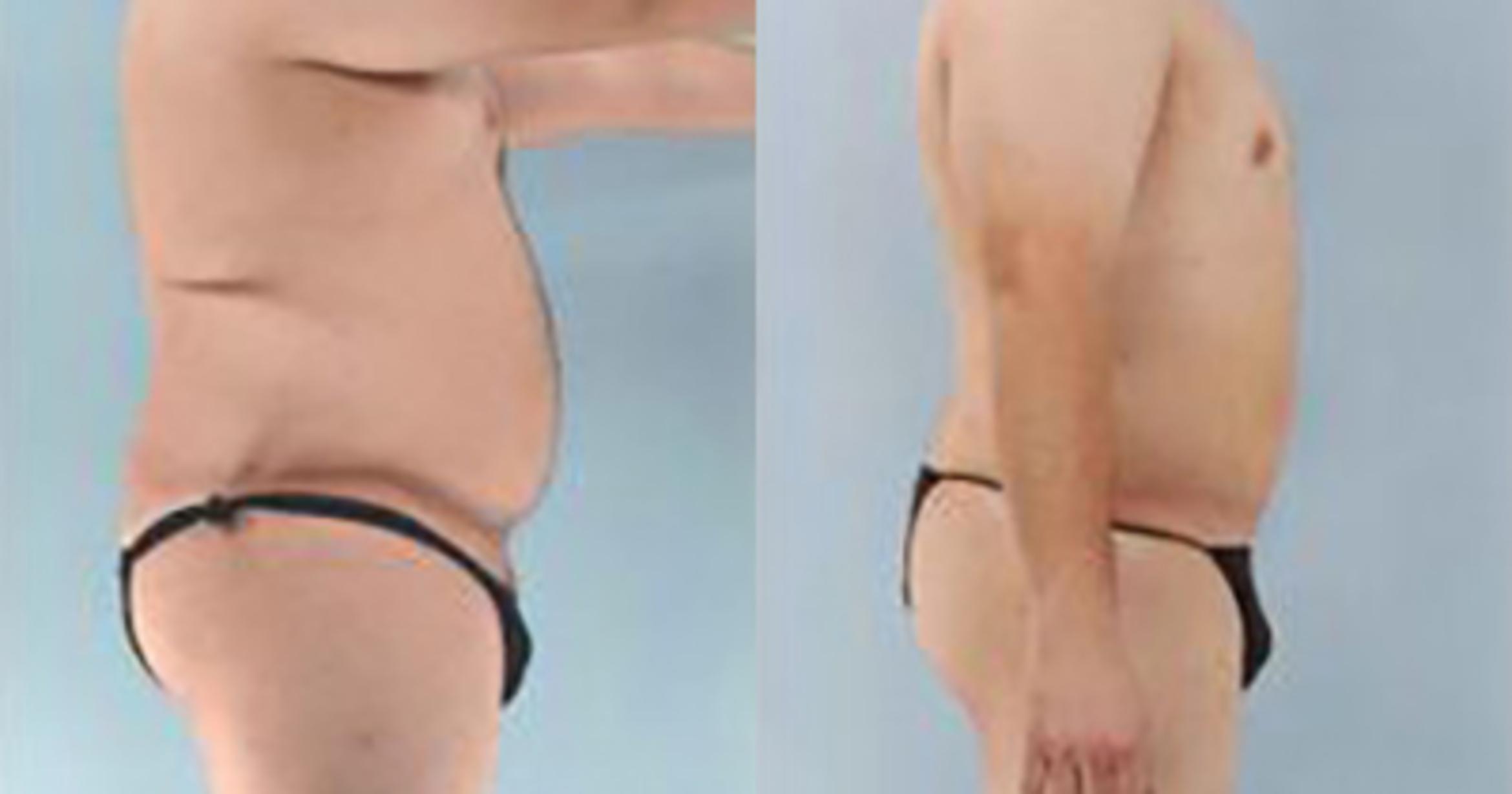 Before & After Liposuction Case 5394 View 3 View in Houston, TX