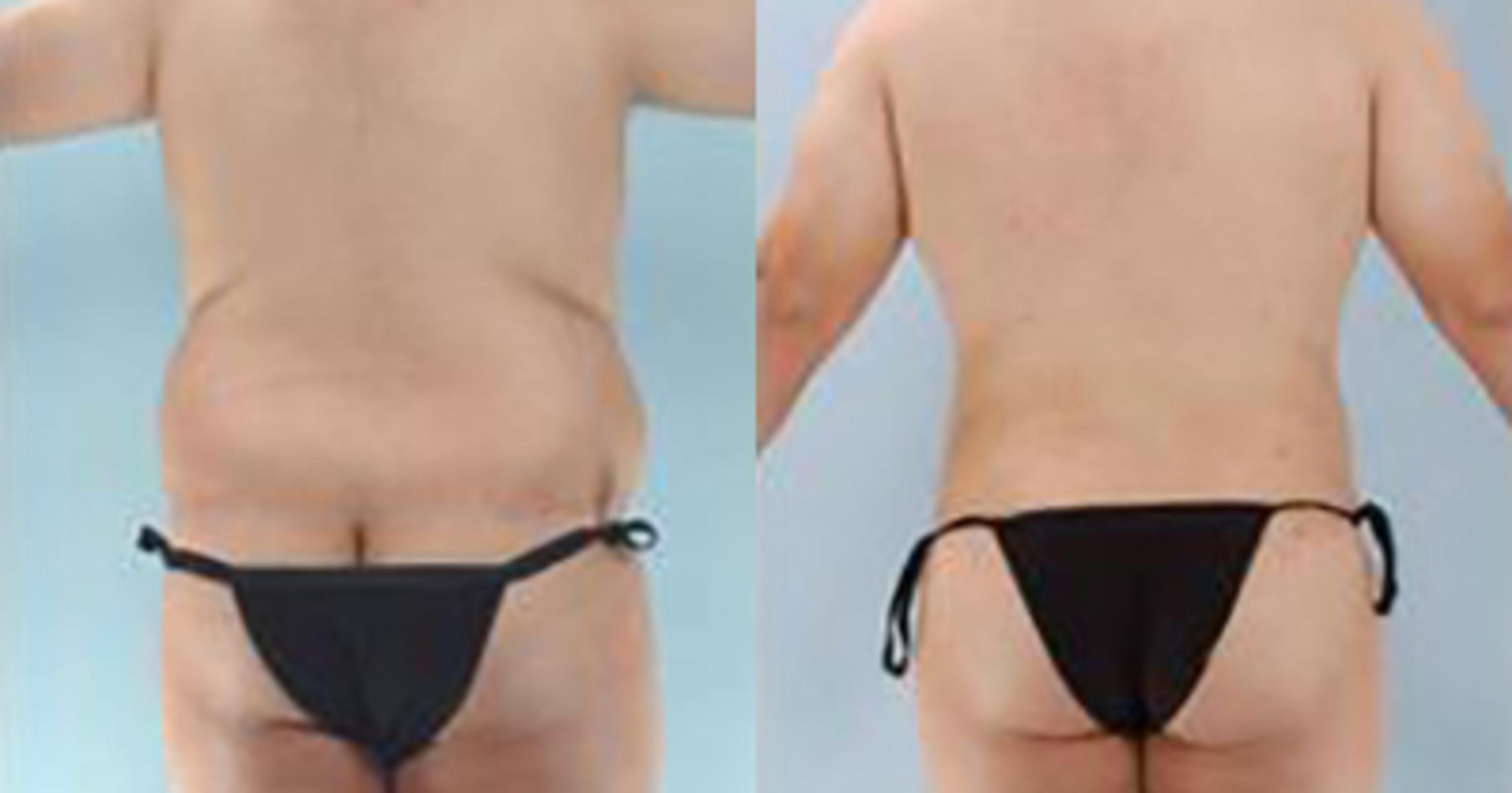 Before & After Liposuction Case 5394 View 4 View in Houston, TX