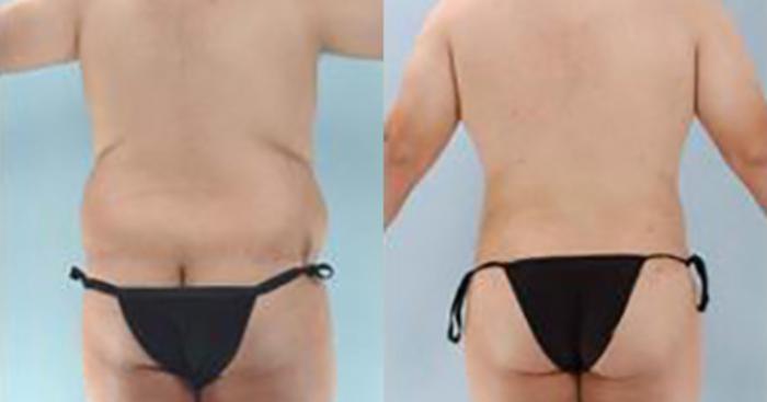 Before & After Liposuction Case 5394 View 4 View in Houston, TX