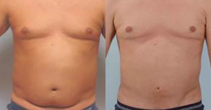 Before & After Liposuction Case 5404 View 1 View in Houston, TX