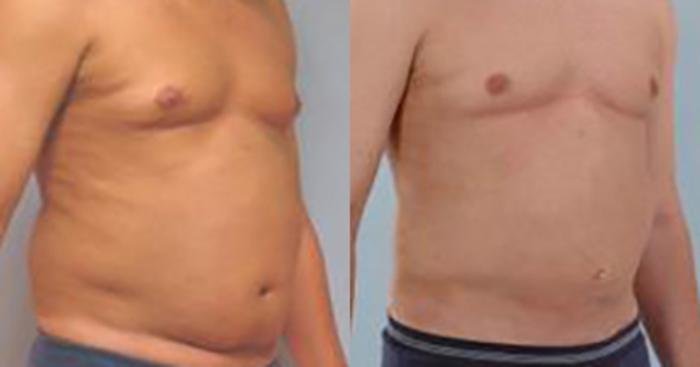 Before & After Liposuction Case 5404 View 2 View in Houston, TX