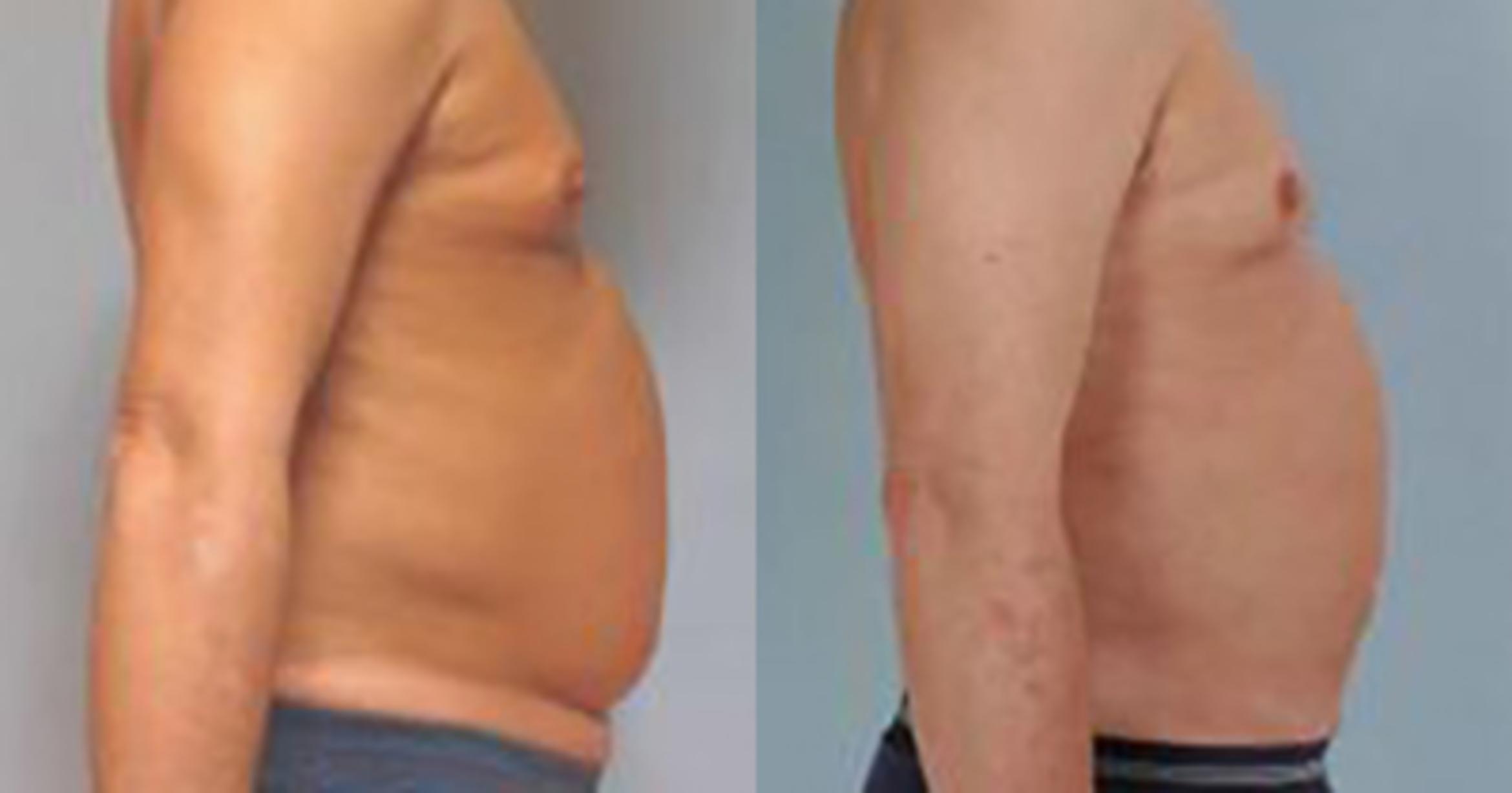 Before & After Liposuction Case 5404 View 3 View in Houston, TX