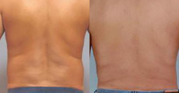 Before & After Liposuction Case 5404 View 4 View in Houston, TX