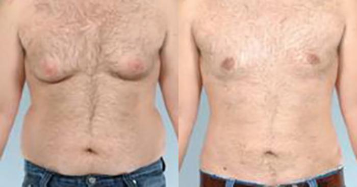 Before & After Liposuction Case 5414 View 1 View in Houston, TX