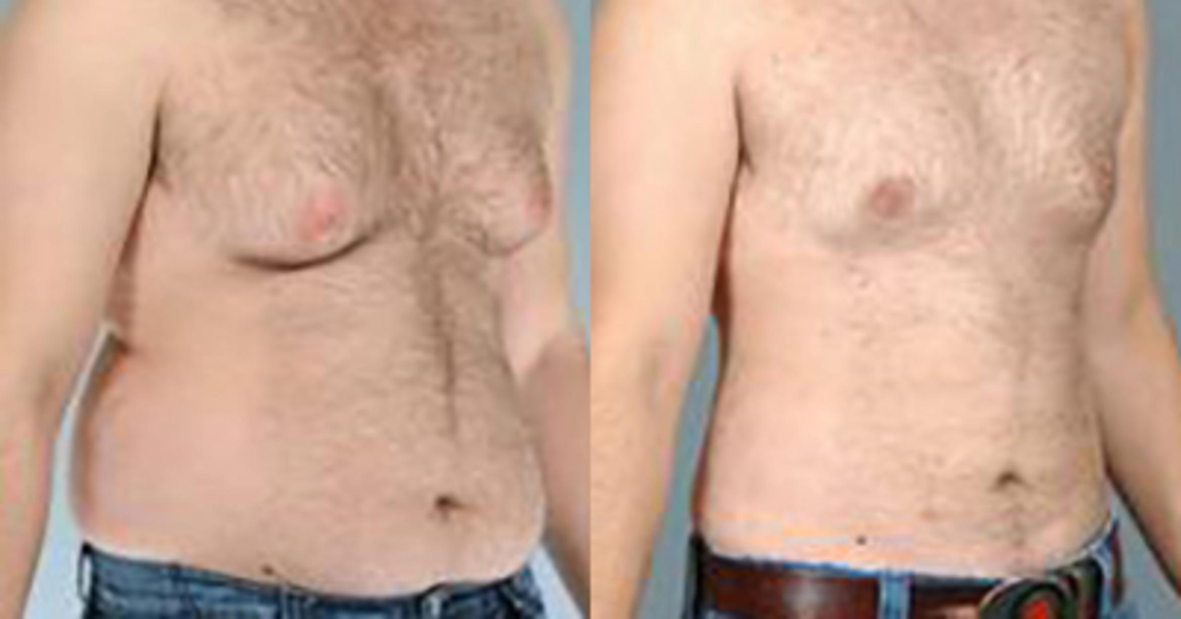 Before & After Liposuction Case 5414 View 2 View in Houston, TX