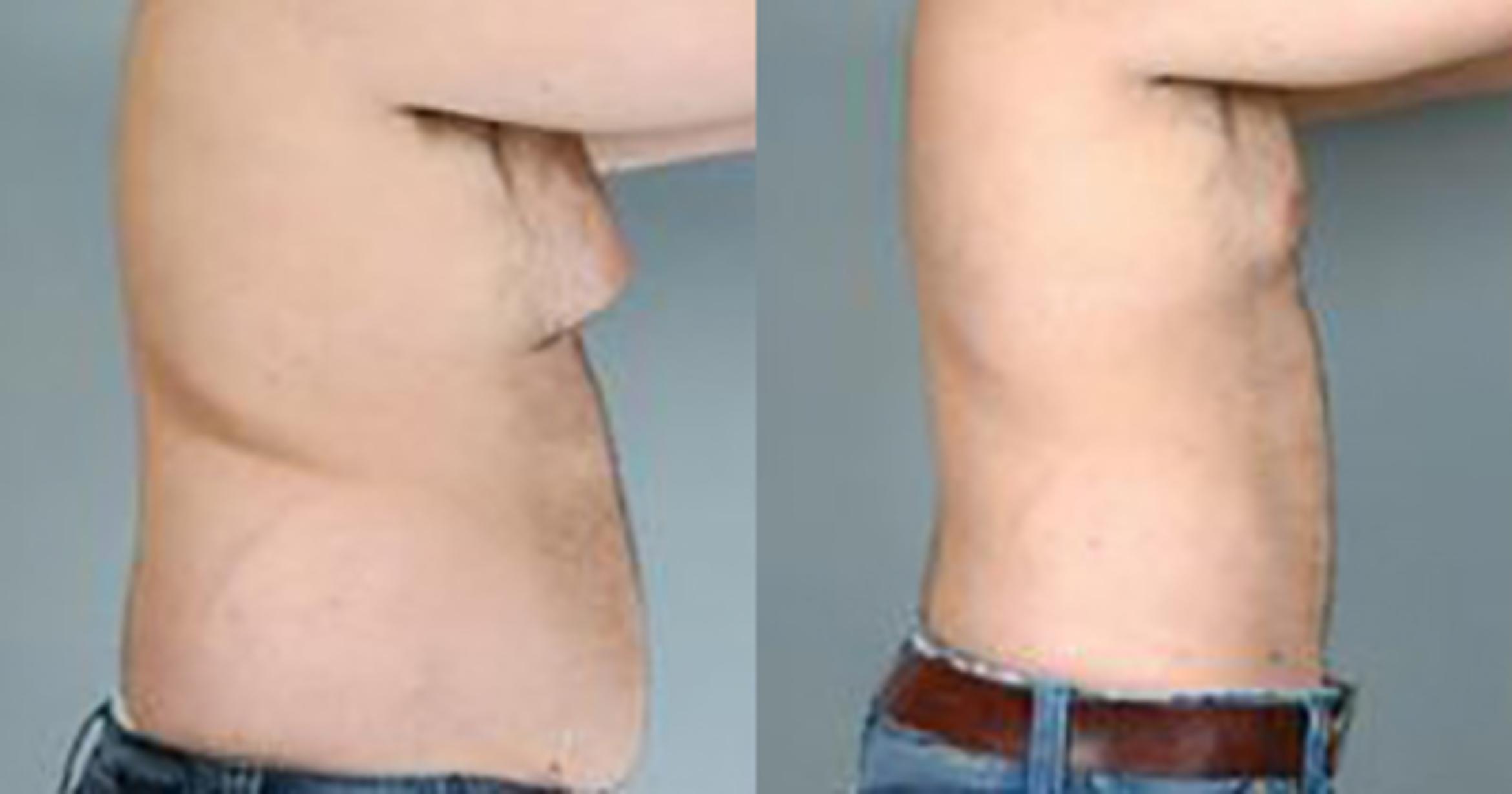 Before & After Liposuction Case 5414 View 3 View in Houston, TX