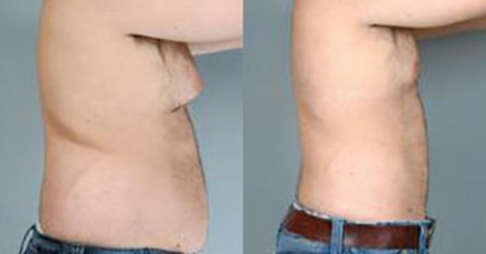 Before & After Liposuction Case 5414 View 3 View in Houston, TX