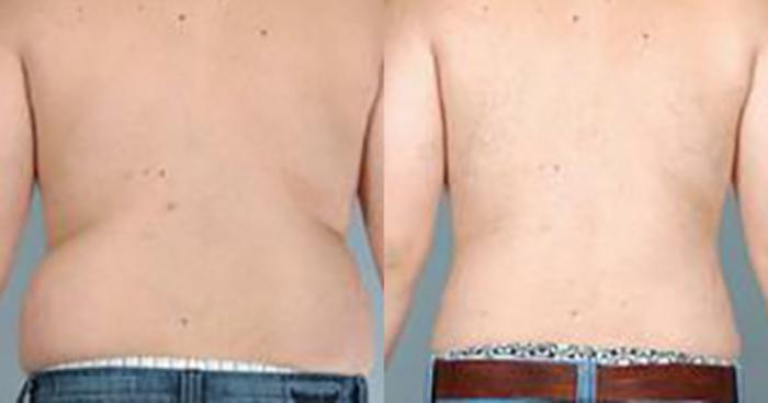 Before & After Liposuction Case 5414 View 4 View in Houston, TX