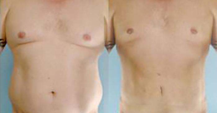 Before & After Liposuction Case 5424 View 1 View in Houston, TX