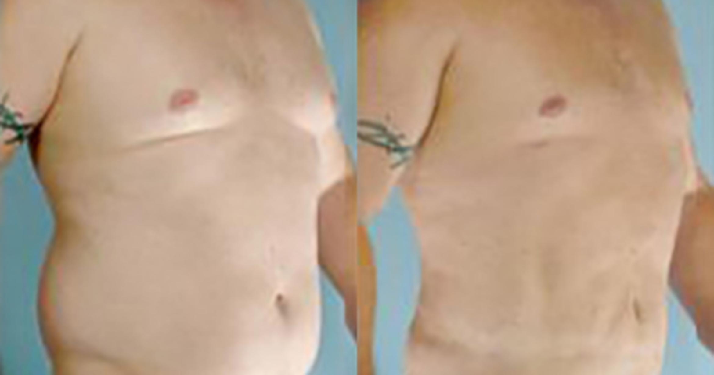Before & After Liposuction Case 5424 View 2 View in Houston, TX