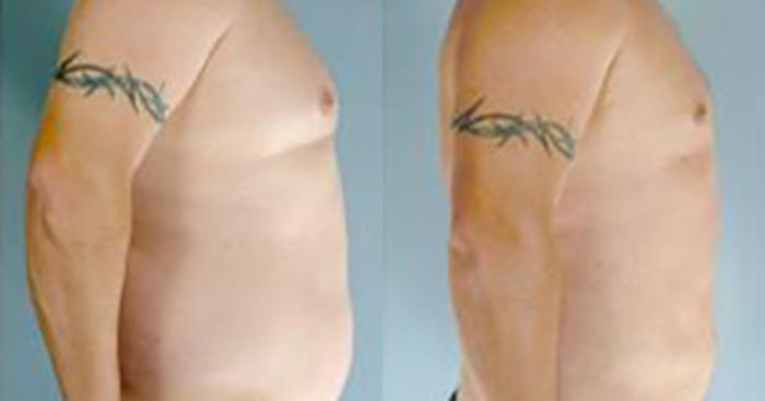 Before & After Liposuction Case 5424 View 3 View in Houston, TX