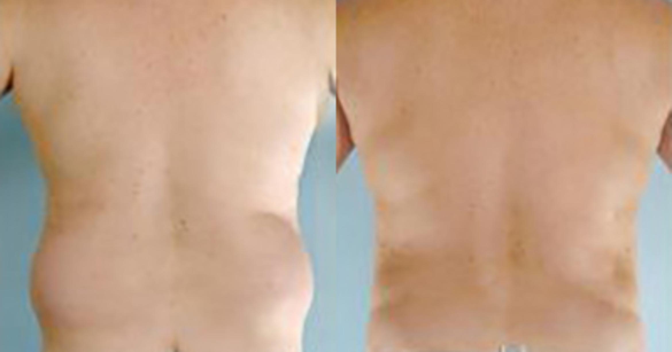 Before & After Liposuction Case 5424 View 4 View in Houston, TX