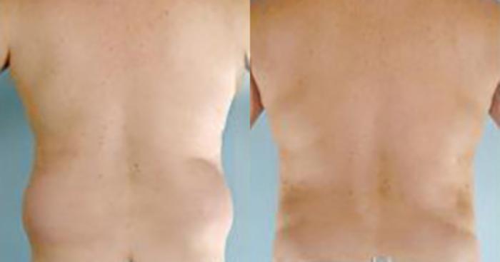 Before & After Liposuction Case 5424 View 4 View in Houston, TX