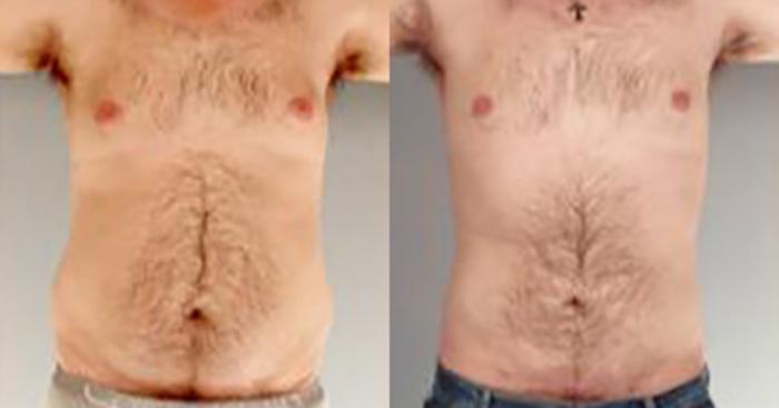Before & After Liposuction Case 5434 View 1 View in Houston, TX