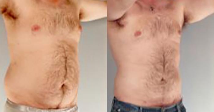 Before & After Liposuction Case 5434 View 2 View in Houston, TX