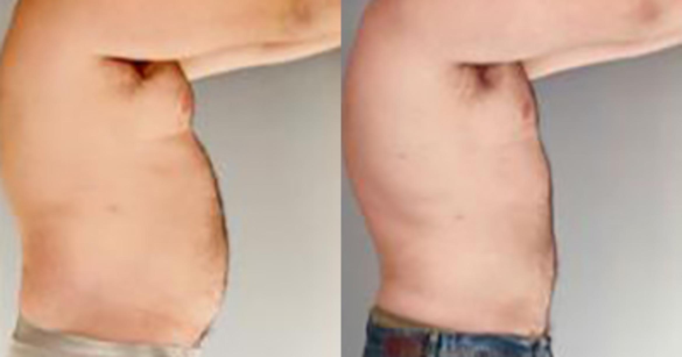 Before & After Liposuction Case 5434 View 3 View in Houston, TX