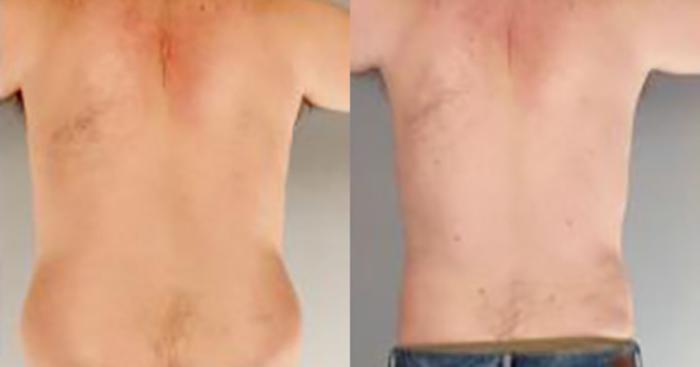 Before & After Liposuction Case 5434 View 4 View in Houston, TX