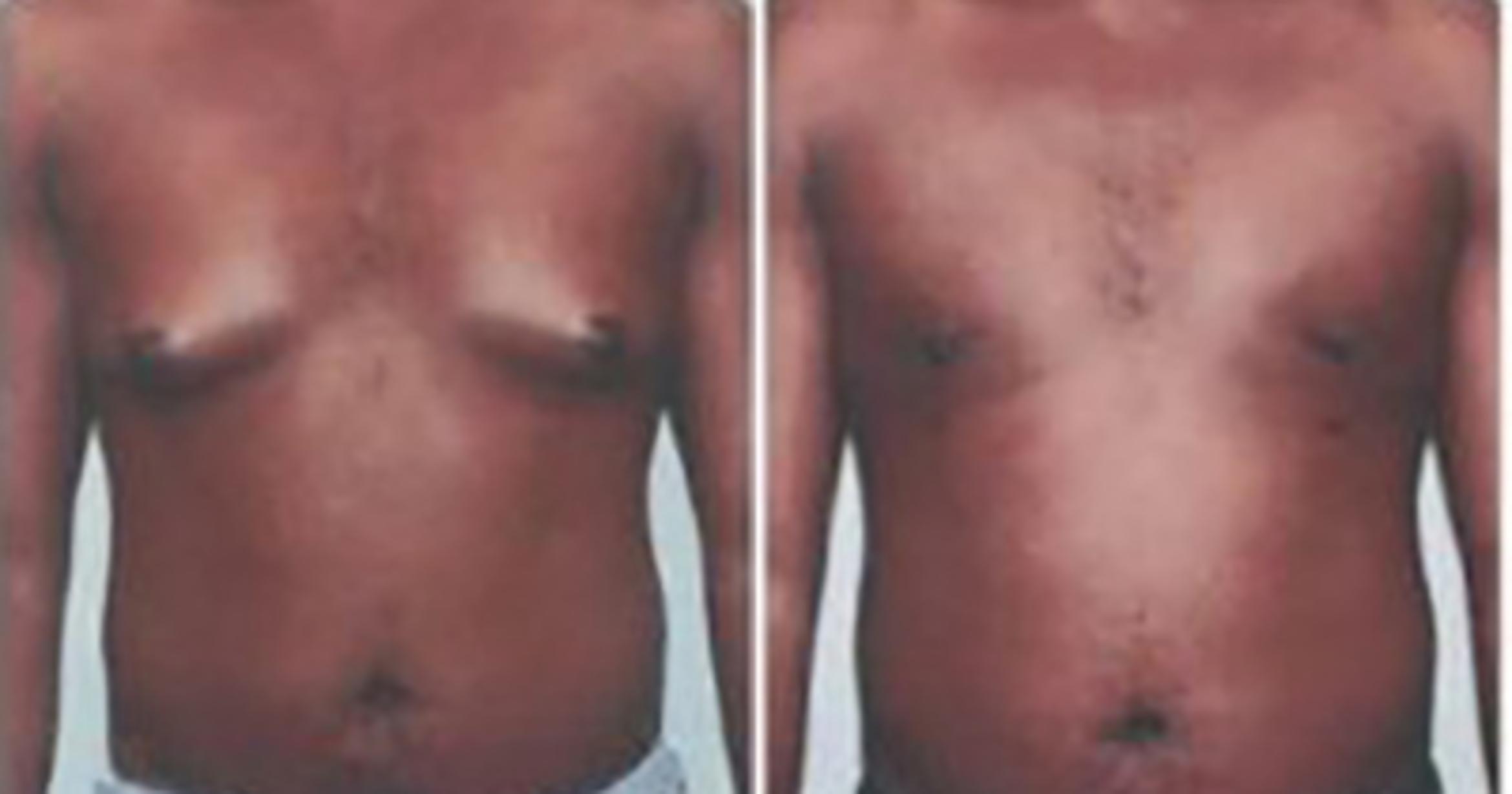 Before & After Liposuction Case 54509999 View 1 View in Houston, TX