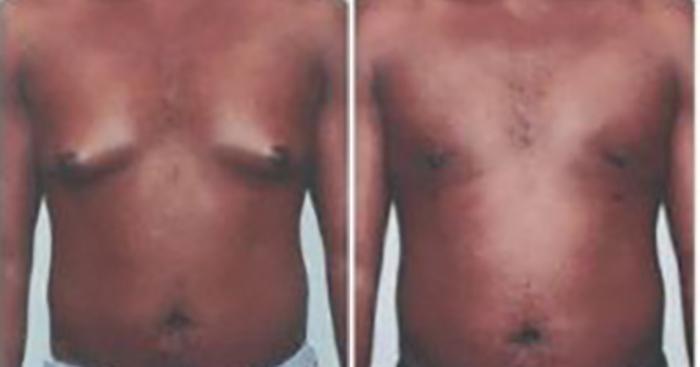 Before & After Liposuction Case 54509999 View 1 View in Houston, TX