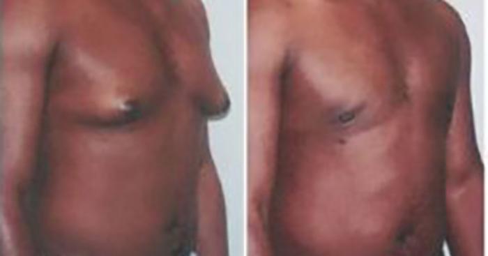 Before & After Liposuction Case 54509999 View 2 View in Houston, TX