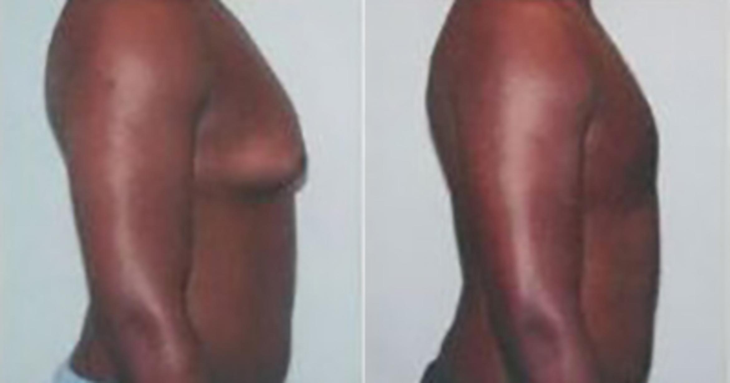 Before & After Liposuction Case 54509999 View 3 View in Houston, TX
